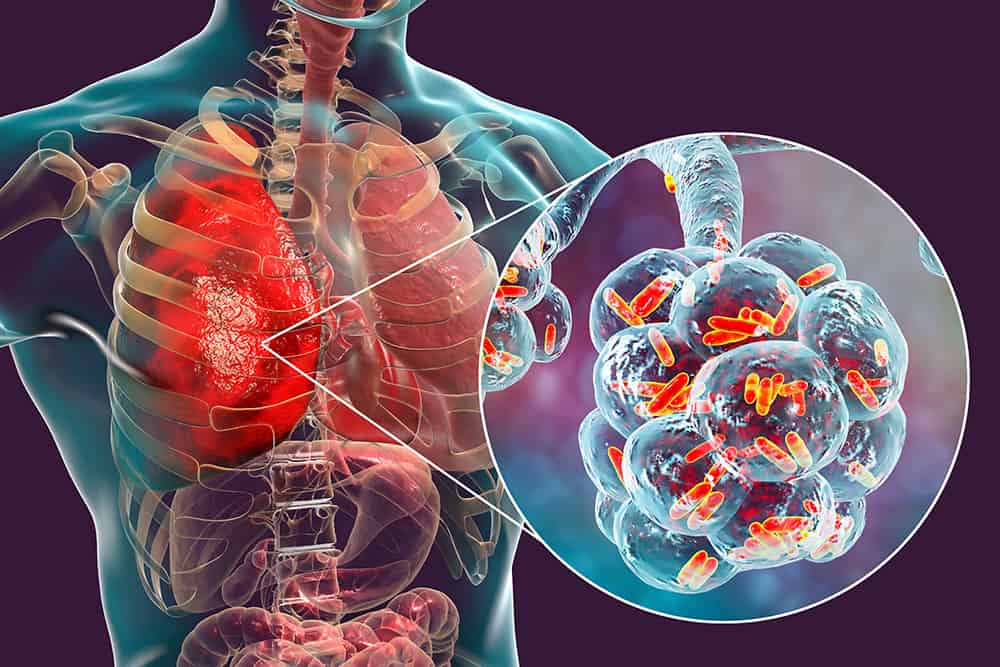 Cayman health authorities investigate confirmed Legionnaires’ disease case