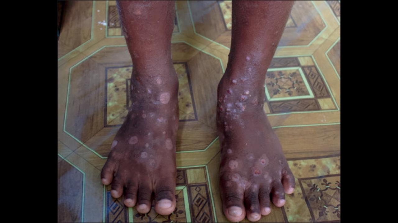 Haiti skin disease - CNW Network