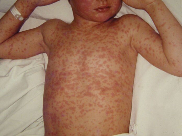 Bermuda investigating possible case of measles